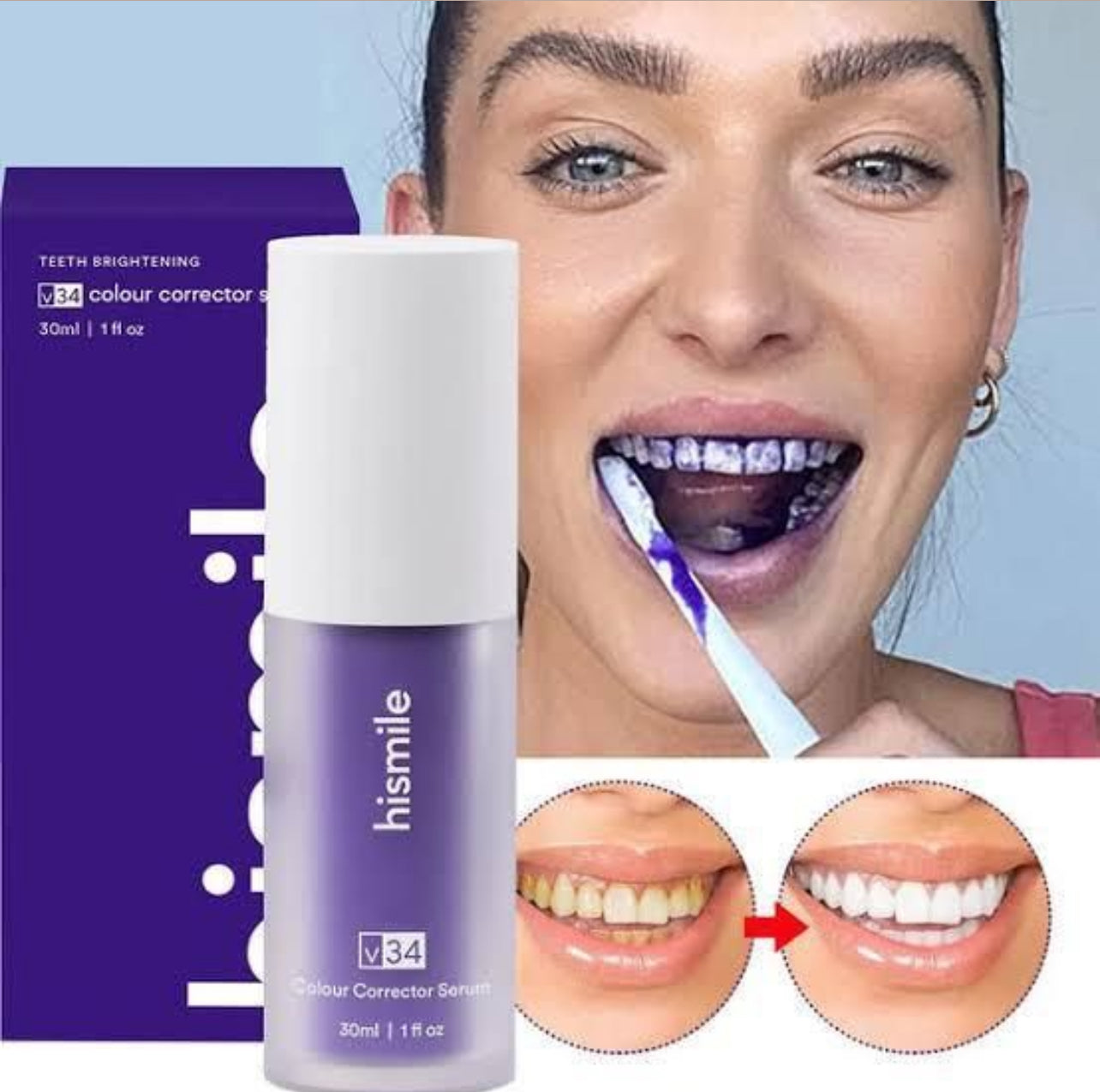 Teeth Whitening