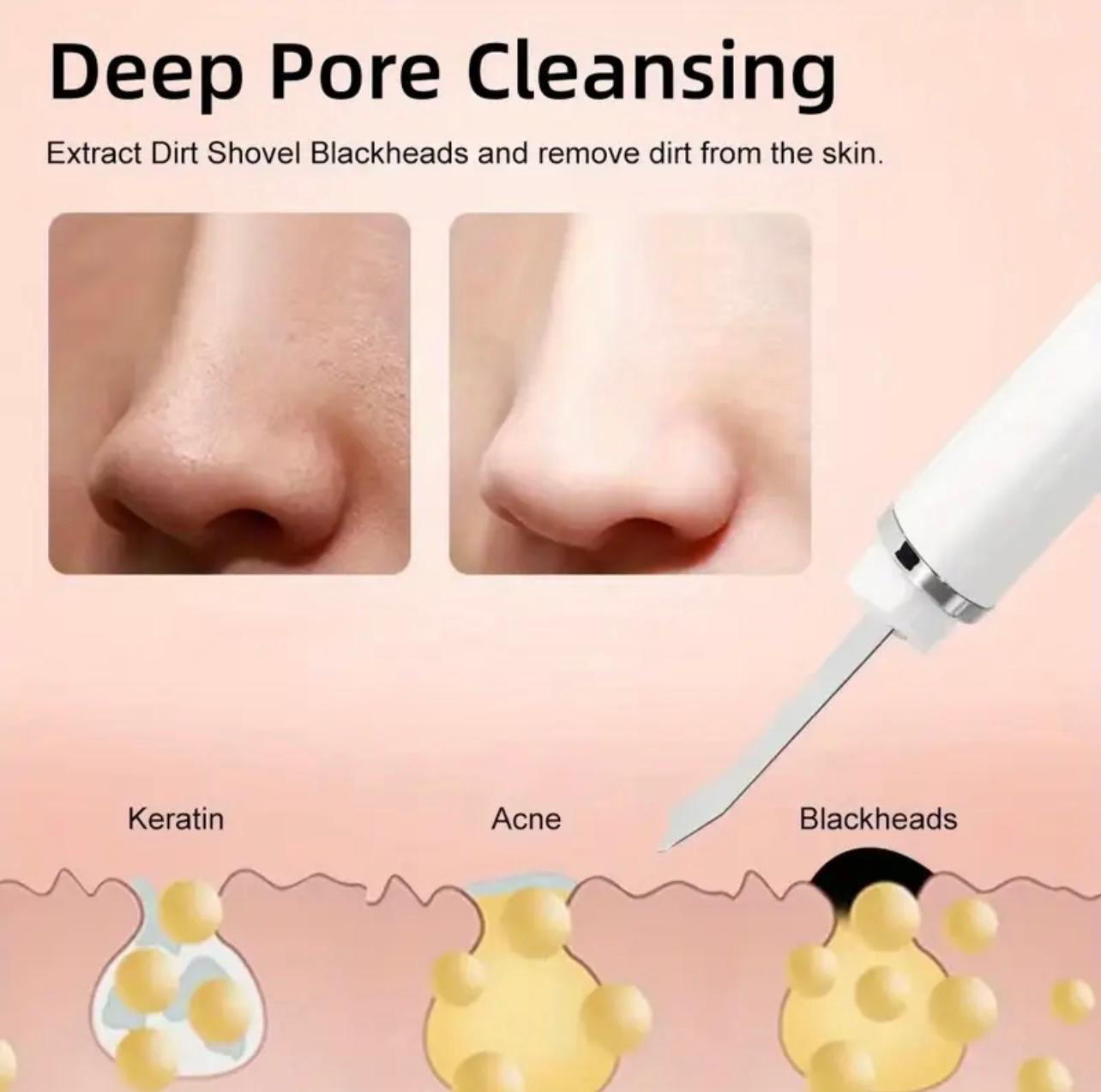 CasaDuzzle™ Electric Blackhead Pore Remover